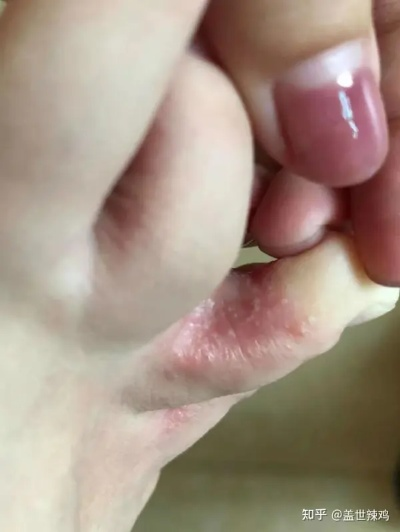 脚上起小水泡还很痒是什么原因(脚上起小水泡很痒是怎么回) 脚上起小水泡还很痒是什么原因(脚上起小水泡很痒是怎么回)