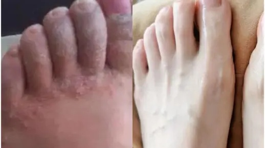 脚上起小水泡很痒是什么原因(脚上起小水泡,痒的厉害怎么办) 脚上起小水泡很痒是什么原因(脚上起小水泡,痒的厉害怎么办)